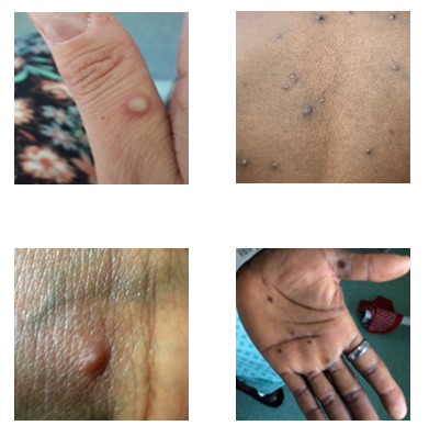 images of mpox rash